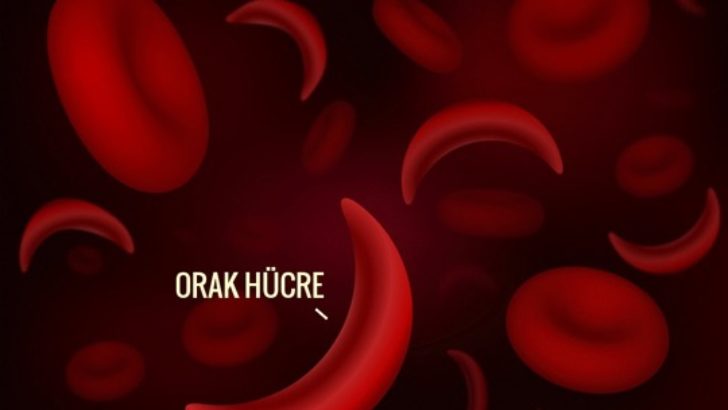 Orak Hücre Anemisi