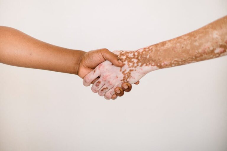 Ala (Vitiligo) Hastalığı
