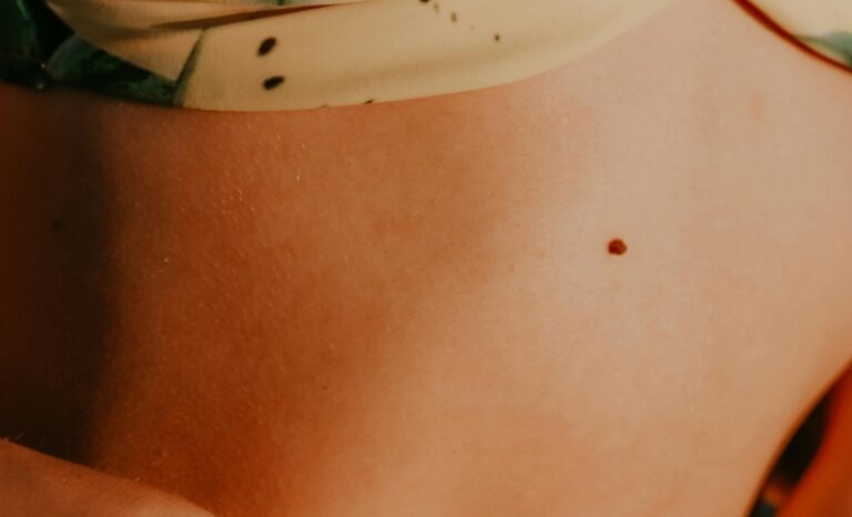 Kan Damarı Tümörleri-Hemangioma