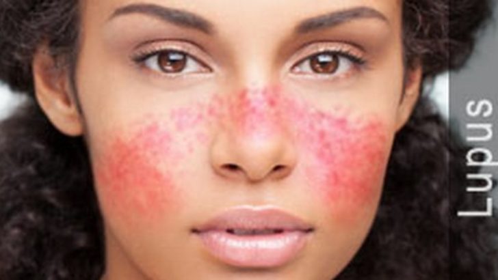 Lupus Hastalığı