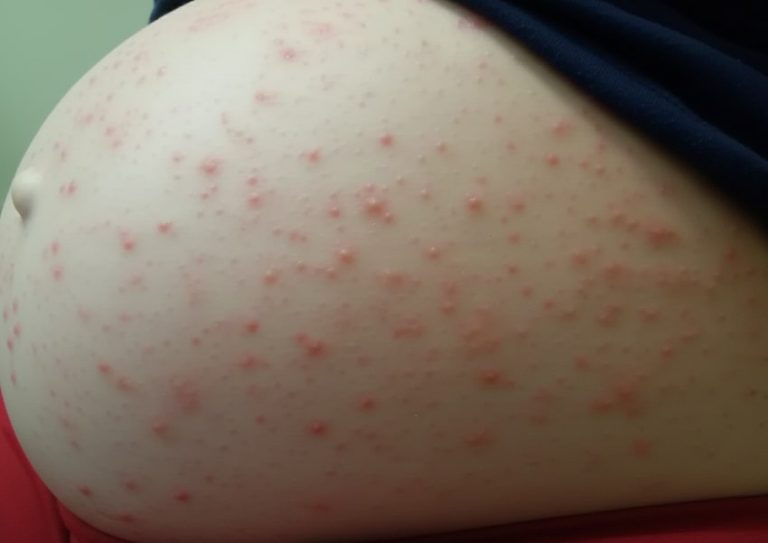 Gebelikte Kaşıntı