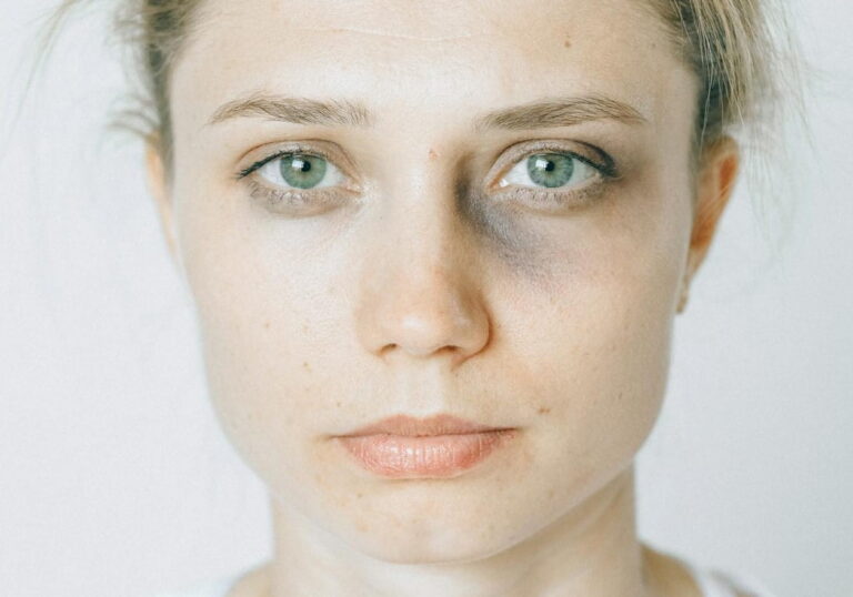 Morluk Neden Oluşur Nasıl Geçer?