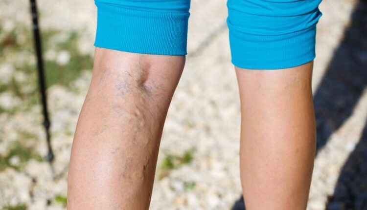 Varisten korunmanın yolları! 1 Varisten korunmanın yolları!