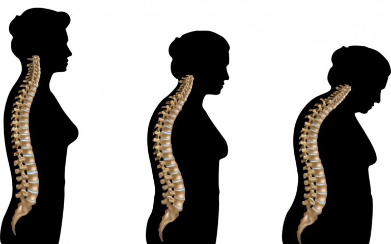 Osteoporoz (Kemik Erimesi) nedir?