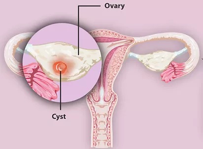 İyi huylu yumurtalık kisti nedir?