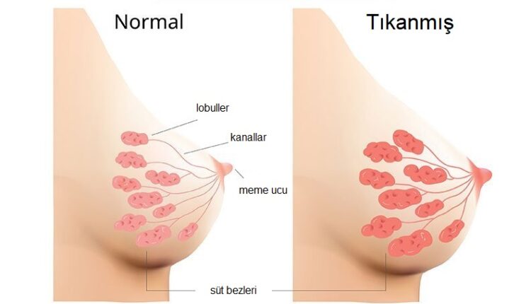 Mastit Nedir? Belirtileri ve Tedavi Yöntemleri Nelerdir?