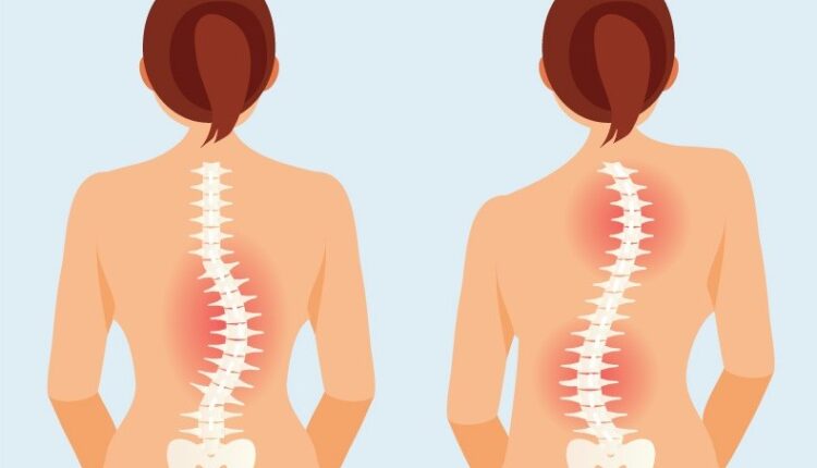 Yetişkin skolyozu belirtileri nelerdir? 
