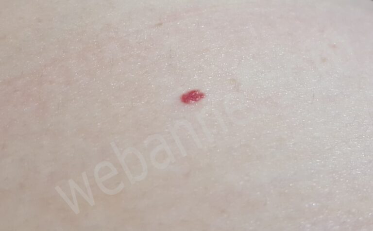 Kırmızı ben nedir, nedenleri ve tedavisi