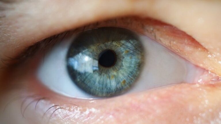 Göz Kapaklarındaki Şişkinlikler Nasıl Önlenir?