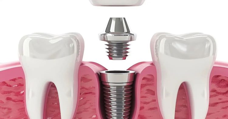 1 gunde implant tedavisi 2