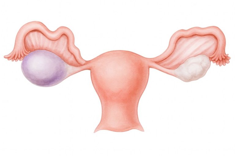 Menopoz Sonrası Yumurtalık Kisti Olur Mu?