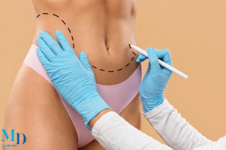 Liposuction: Bölgesel Yağlanmada Kalıcı ve Kontrollü Çözüm
